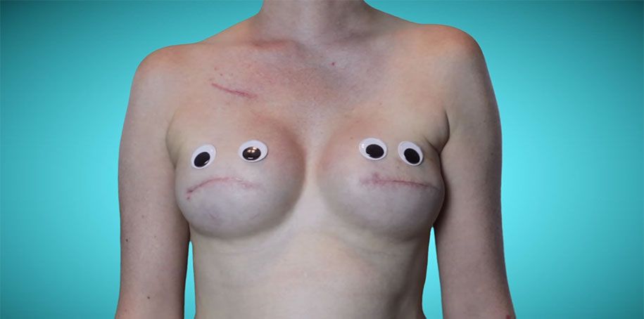 vėžys-mastektomija-nuotraukų serija-mano krūtis-pasirinkimas-aniela-mcguinness-6