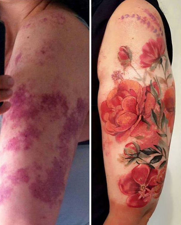 creative-tattoos-birthmark-cover-ups-8